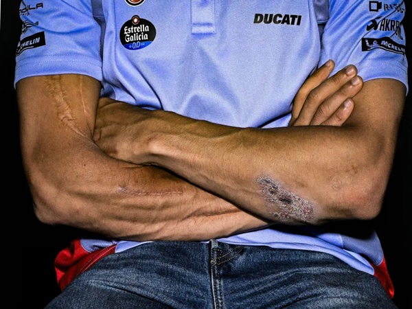 Bekas Luka Marc Marquez di Tangannya Menarik Perhatian