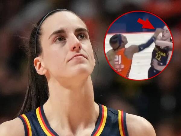 Caitlin Clark mengalami memar di mata kanannya setelah kena colok tangan DiJonai Carrington. (Foto: AP)