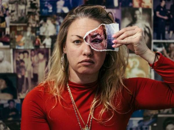 Heather Hardy berpose dengan sobekan foto mata kirinya yang terluka parah setelah pertarungannya pada 2018. (Foto: ESPN)