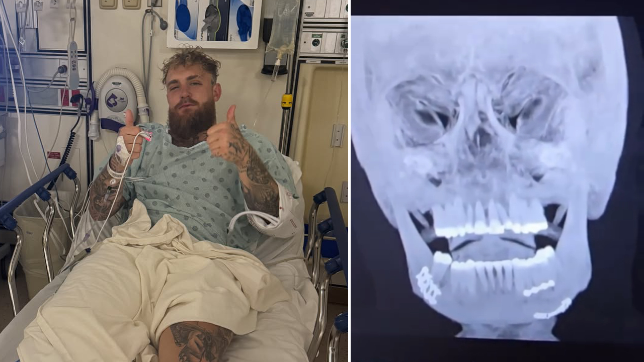 Setelah Operasi Rahang, Jake Paul Hanya Bisa Konsumsi Cairan Selama Sepekan