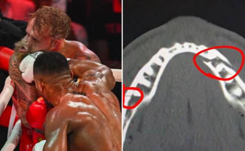 Rahang Jake Paul Patah Parah, Dilarikan ke Rumah Sakit Usai Di-KO Joshua