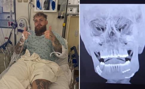 Setelah Operasi Rahang, Jake Paul Hanya Bisa Konsumsi Cairan Selama Sepekan