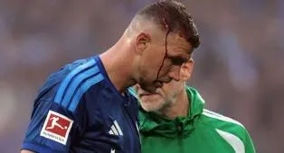Kepalanya Bocor Saat Lawan Mainz, Edin Dzeko Berpeluang Absen Lawan Koln
